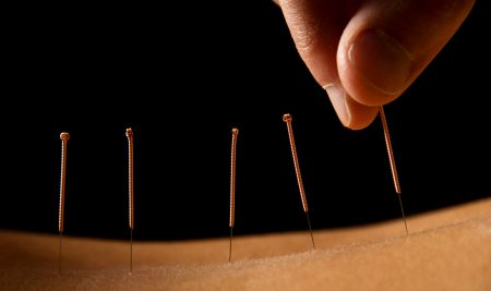 Acupuncture Treatment
